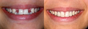 Dental Implant result