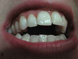 woman's teeth and gums